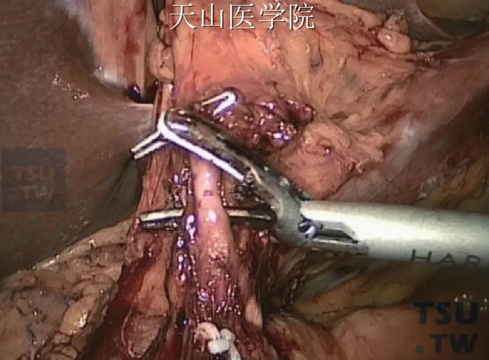看图说话：腹腔镜远端胃大部切除术详解