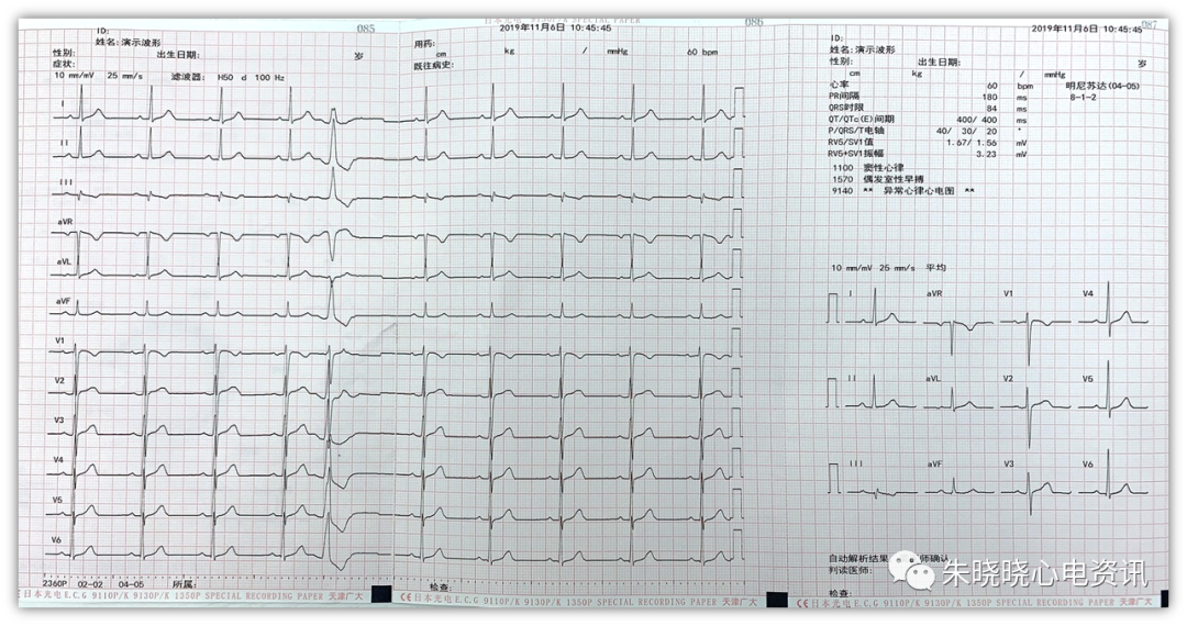 心电图分析三步曲（粗读、细读、结合临床诊断）