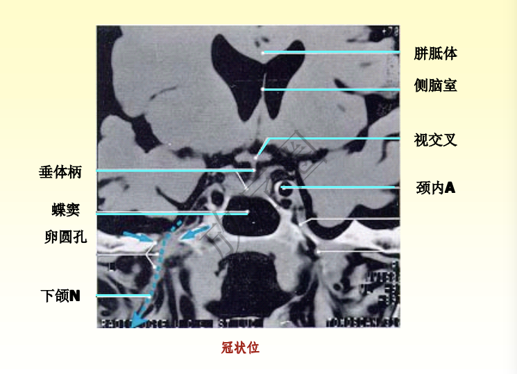 鼻咽癌调强放疗靶区勾画原则