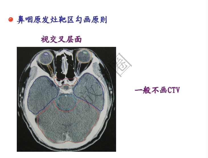 鼻咽癌调强放疗靶区勾画原则