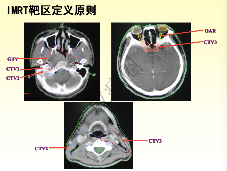 鼻咽癌调强放疗靶区勾画原则