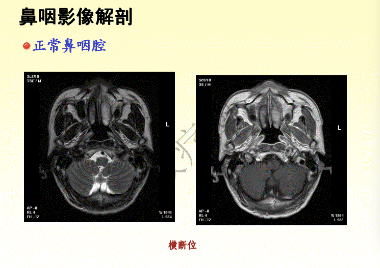 鼻咽癌调强放疗靶区勾画原则