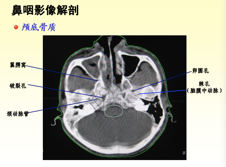 鼻咽癌调强放疗靶区勾画原则