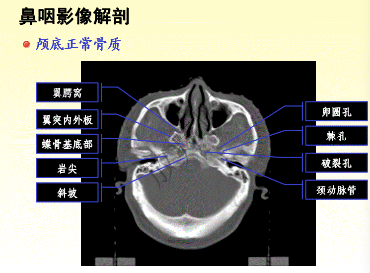 鼻咽癌调强放疗靶区勾画原则