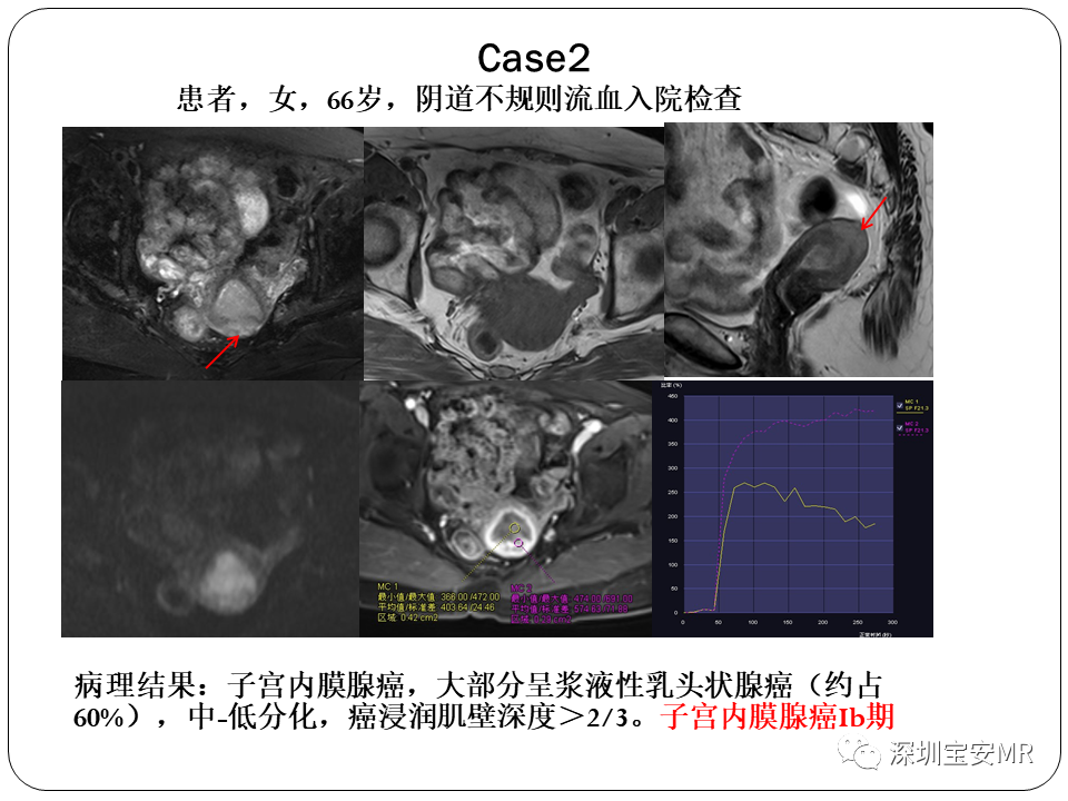 子宫内膜癌MRI诊断及鉴别诊断