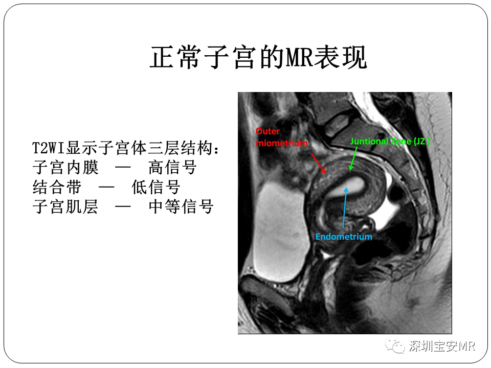 子宫内膜癌MRI诊断及鉴别诊断