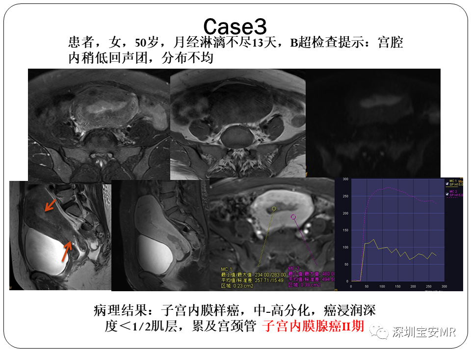 子宫内膜癌MRI诊断及鉴别诊断