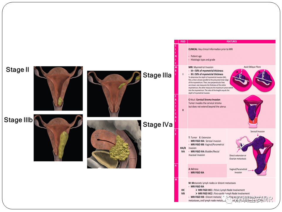 子宫内膜癌MRI诊断及鉴别诊断