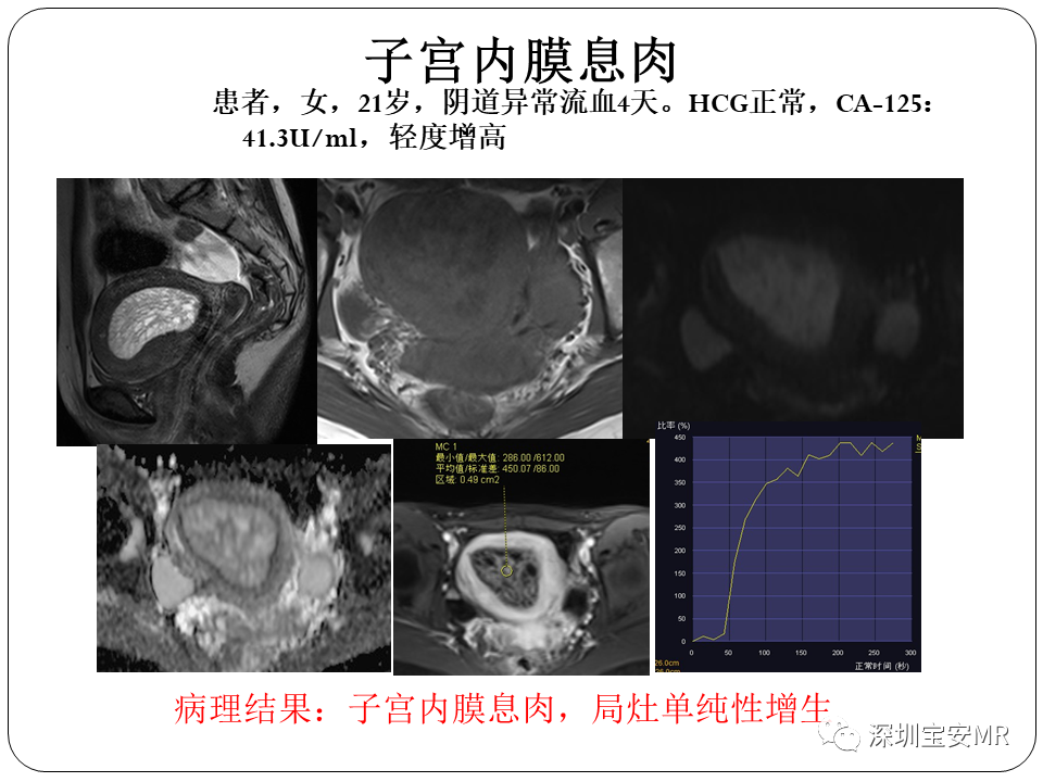 子宫内膜癌MRI诊断及鉴别诊断