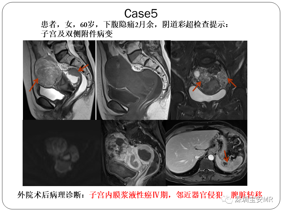 子宫内膜癌MRI诊断及鉴别诊断