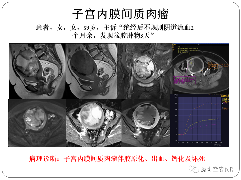 子宫内膜癌MRI诊断及鉴别诊断