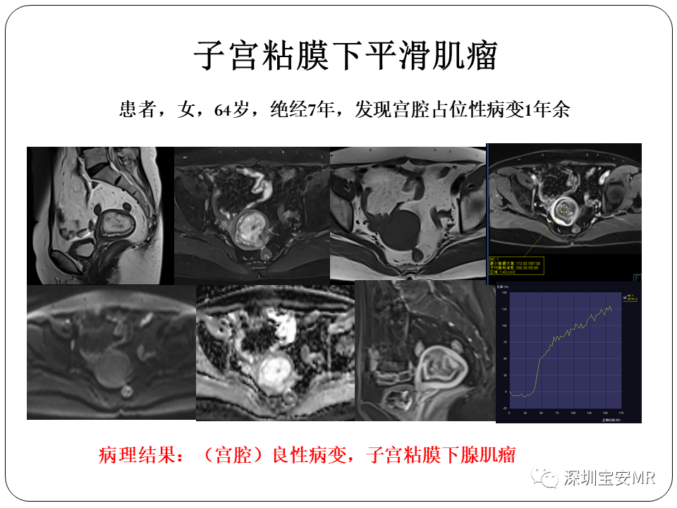 子宫内膜癌MRI诊断及鉴别诊断