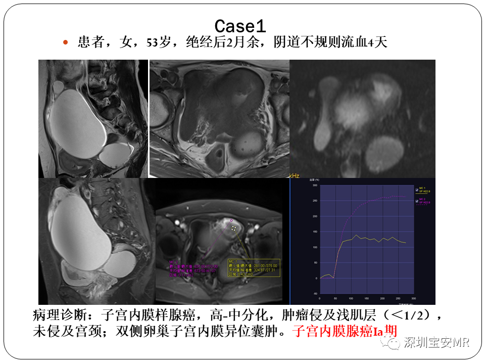 子宫内膜癌MRI诊断及鉴别诊断