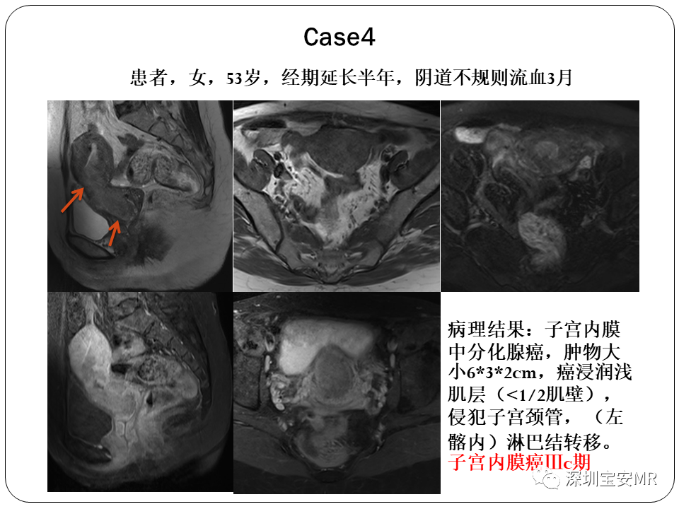 子宫内膜癌MRI诊断及鉴别诊断