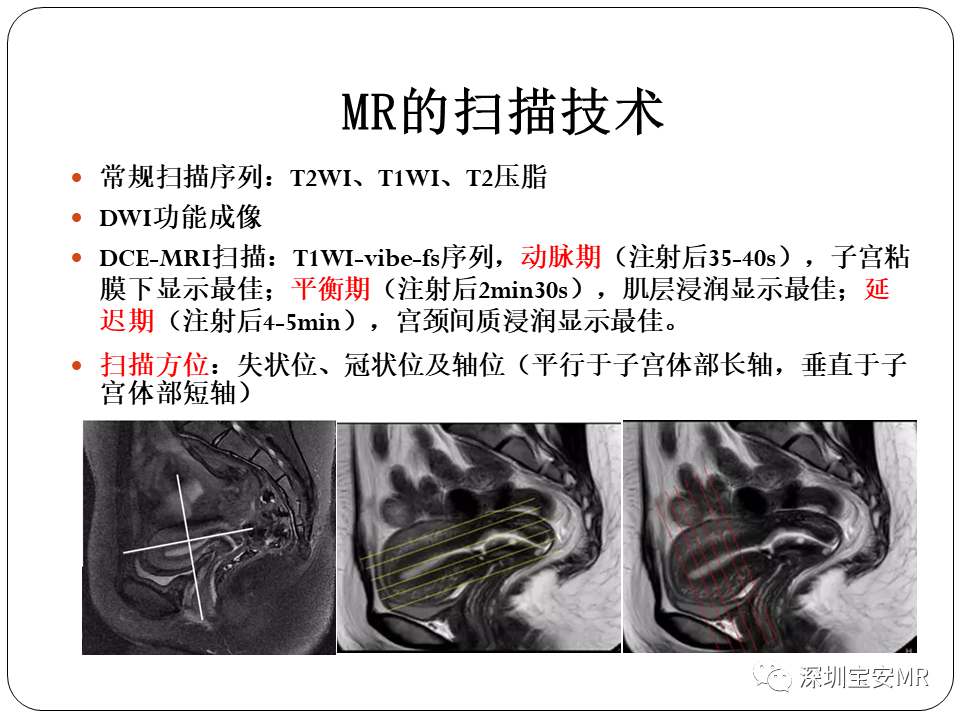 子宫内膜癌MRI诊断及鉴别诊断