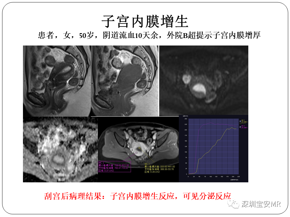 子宫内膜癌MRI诊断及鉴别诊断