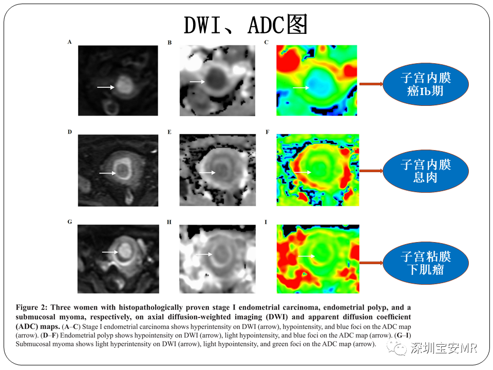 子宫内膜癌MRI诊断及鉴别诊断