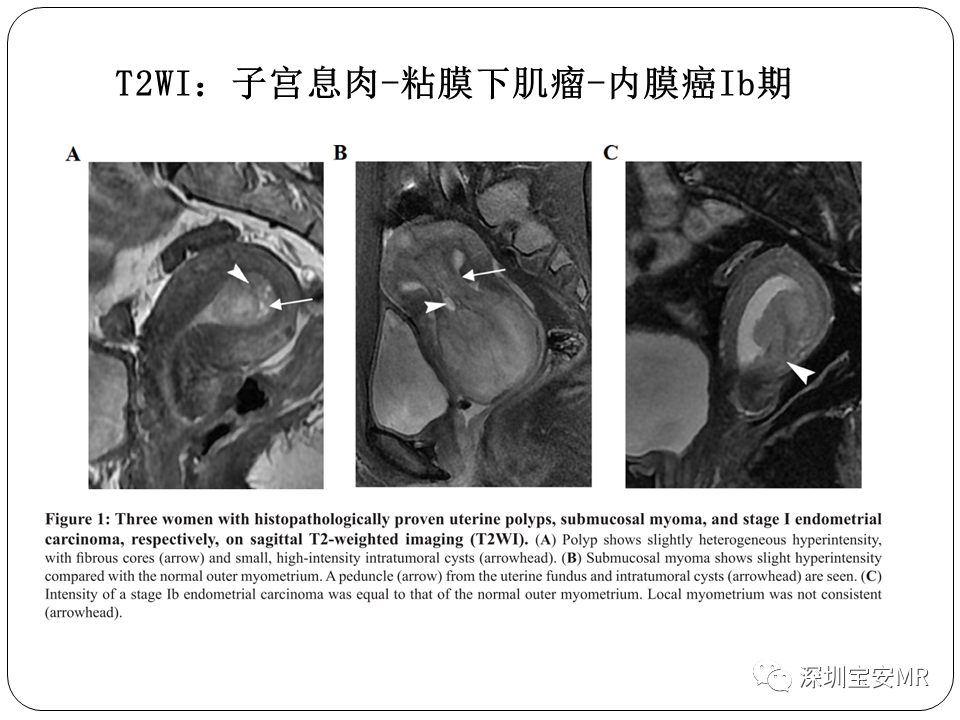 子宫内膜癌MRI诊断及鉴别诊断