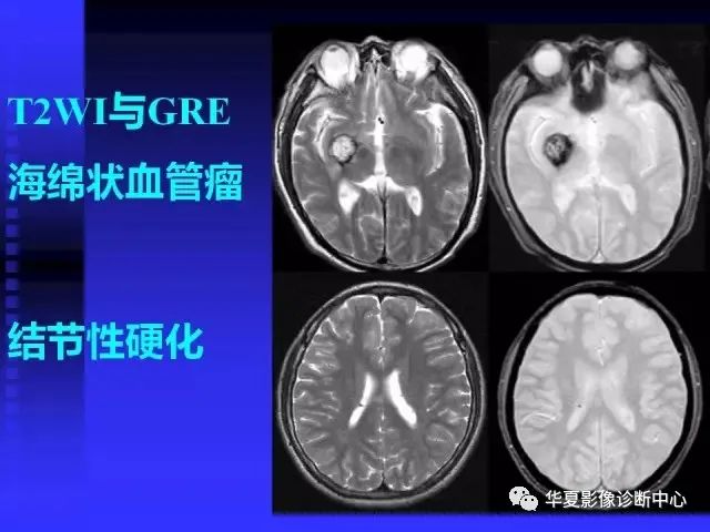 入门必修课：头颅MRI读片详解