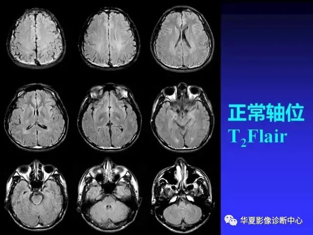 入门必修课：头颅MRI读片详解