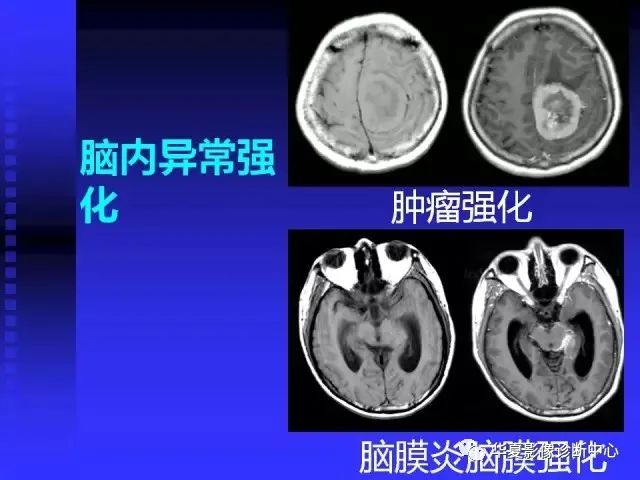 入门必修课：头颅MRI读片详解