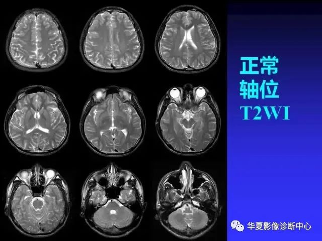 入门必修课：头颅MRI读片详解