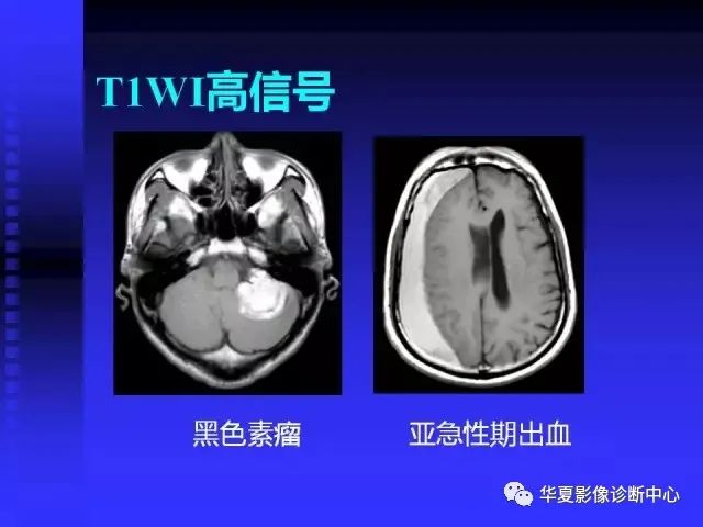 入门必修课：头颅MRI读片详解