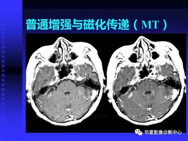 入门必修课：头颅MRI读片详解