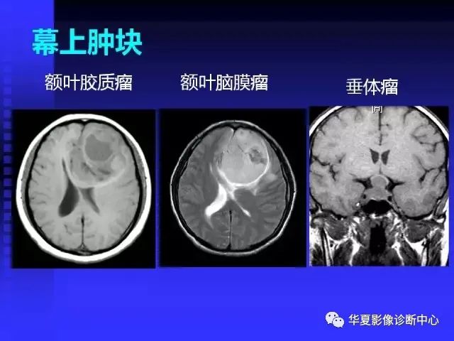 入门必修课：头颅MRI读片详解