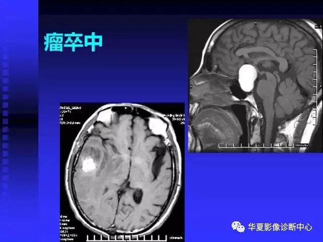 入门必修课：头颅MRI读片详解