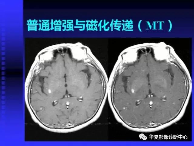 入门必修课：头颅MRI读片详解