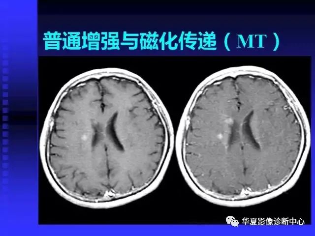 入门必修课：头颅MRI读片详解