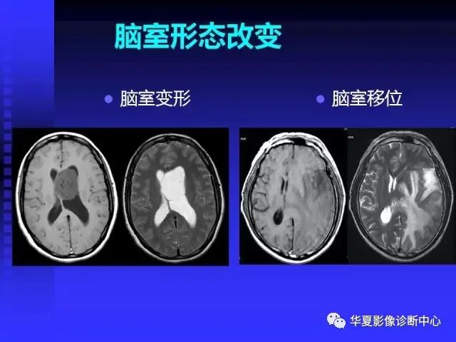 入门必修课：头颅MRI读片详解