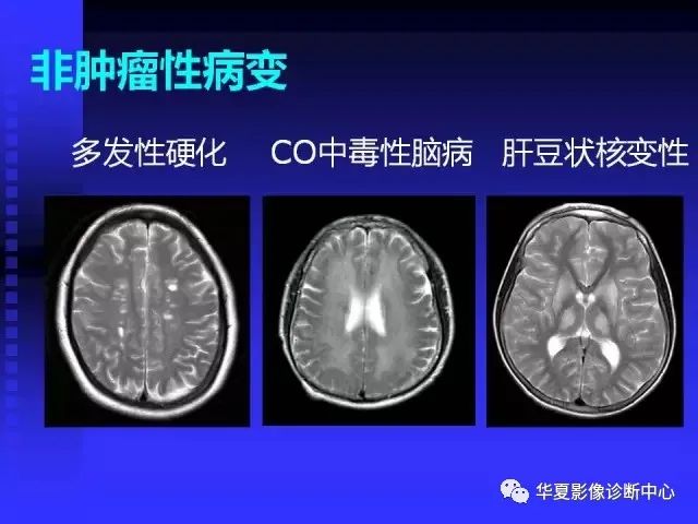 入门必修课：头颅MRI读片详解