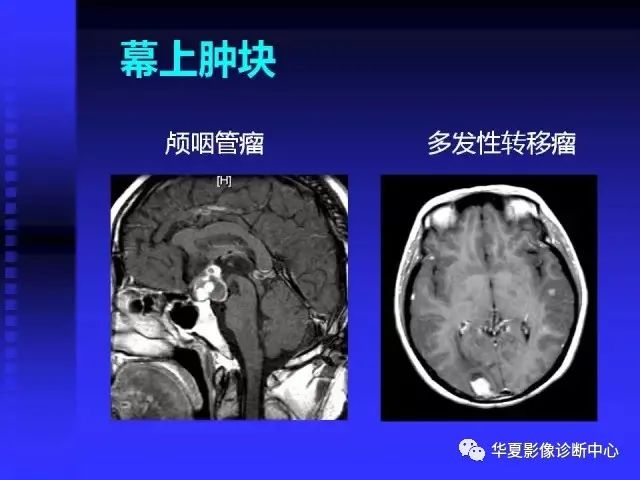 入门必修课：头颅MRI读片详解