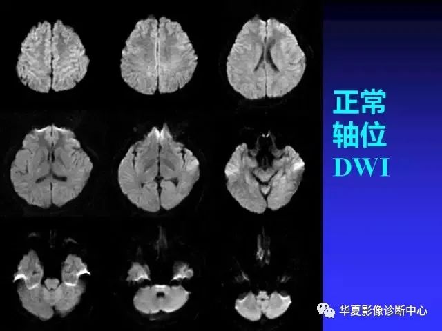 入门必修课：头颅MRI读片详解