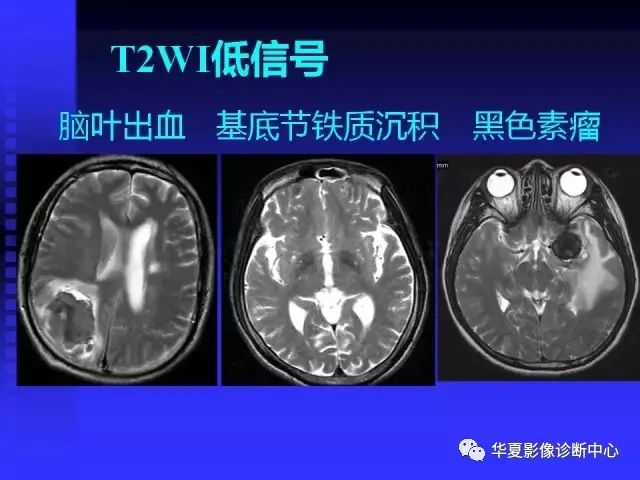 入门必修课：头颅MRI读片详解