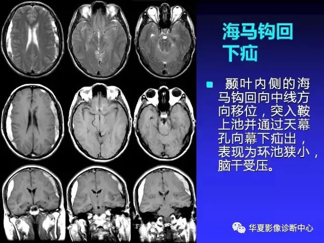 入门必修课：头颅MRI读片详解