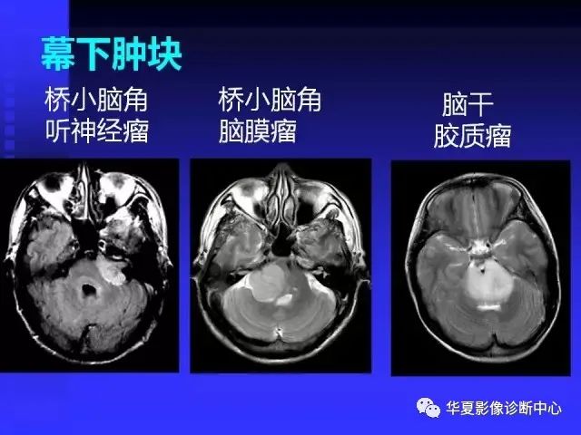 入门必修课：头颅MRI读片详解