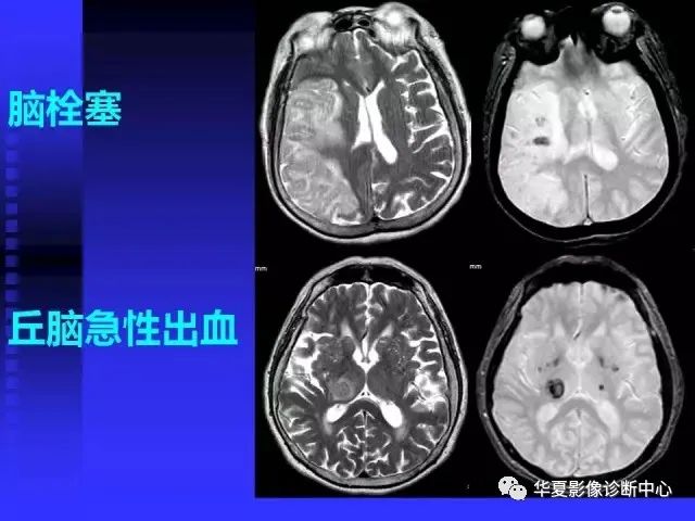 入门必修课：头颅MRI读片详解