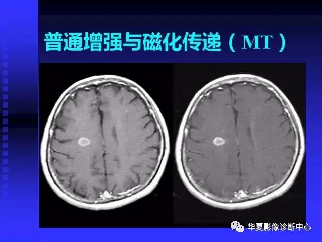 入门必修课：头颅MRI读片详解