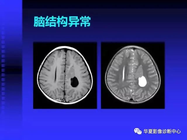 入门必修课：头颅MRI读片详解