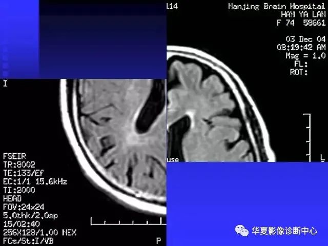 入门必修课：头颅MRI读片详解