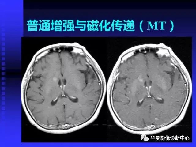 入门必修课：头颅MRI读片详解