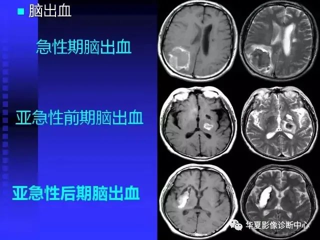 入门必修课：头颅MRI读片详解