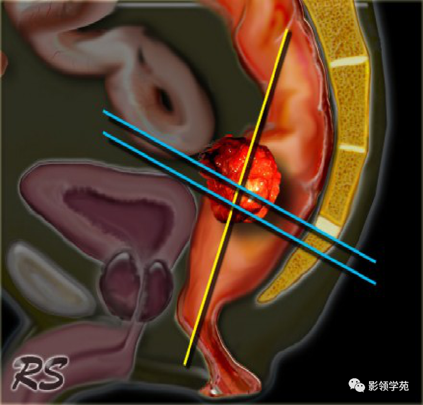 【图文详解】直肠癌MRI分期，你想知道的都在这里！