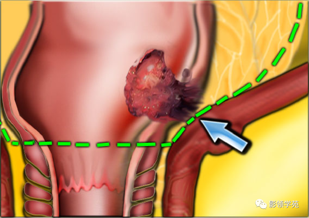 【图文详解】直肠癌MRI分期，你想知道的都在这里！