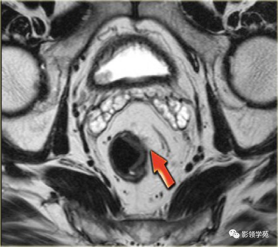 【图文详解】直肠癌MRI分期，你想知道的都在这里！