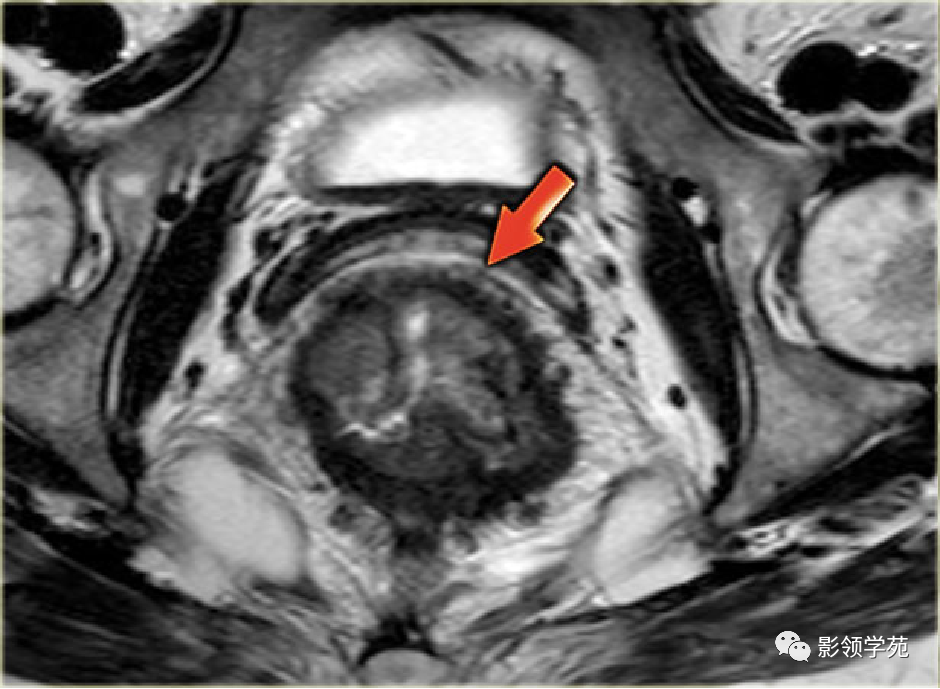 【图文详解】直肠癌MRI分期，你想知道的都在这里！