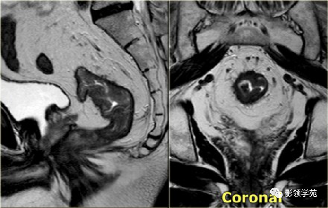 【图文详解】直肠癌MRI分期，你想知道的都在这里！